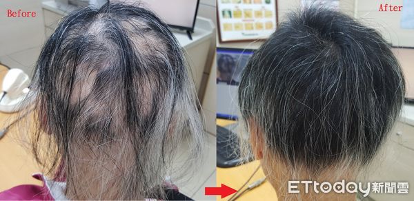 ▲婦人大量掉髮模樣嚇人，就醫後找回髮量。（圖／記者許宥孺翻攝）