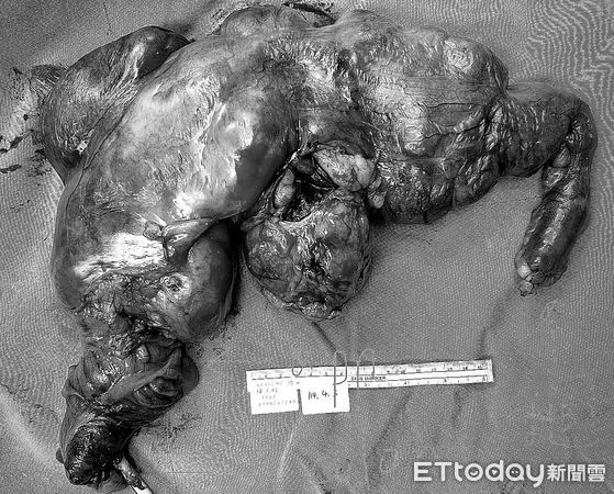全球罕見！34歲男腹脹揭百顆小腸腫瘤。（圖／中山醫院提供）